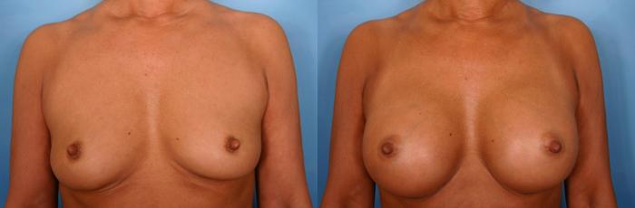 Before & After Breast Augmentation Case 40 View #1 View in Naples and Ft. Myers, FL