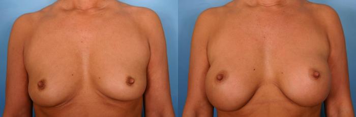 Before & After Breast Augmentation Case 40 View #2 View in Naples and Ft. Myers, FL