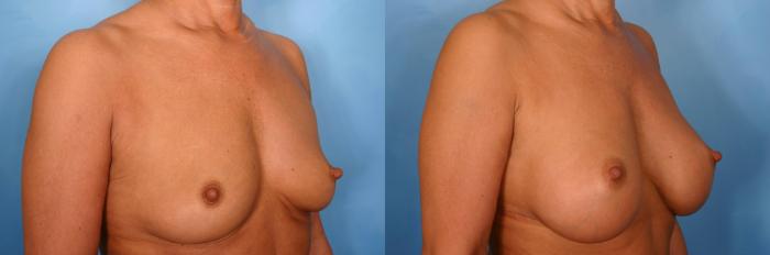 Before & After Breast Augmentation Case 40 View #3 View in Naples and Ft. Myers, FL
