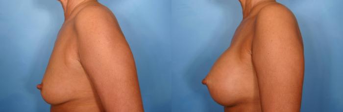 Before & After Breast Augmentation Case 40 View #4 View in Naples and Ft. Myers, FL