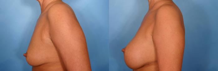 Before & After Breast Augmentation Case 40 View #5 View in Naples and Ft. Myers, FL