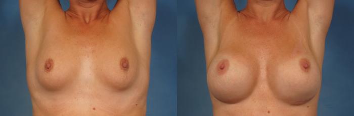Front Arms Raised view of Breast Augmentation by Dr. Kent Hasen, Before