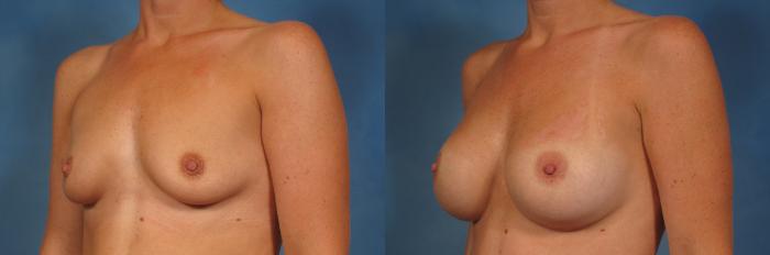 Left Oblique view of Silicone Breast Augmentation by Dr. Kent Hasen in 46 year old woman, Before