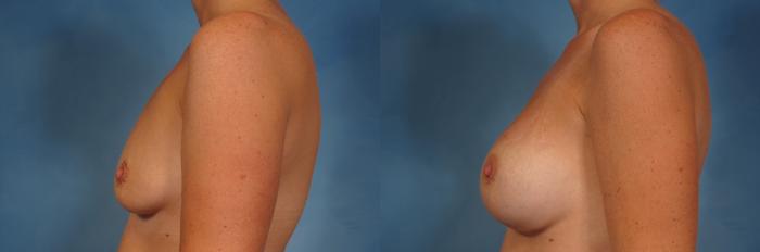 Left Side view of Silicone Breast Augmentation by Dr. Kent Hasen in 46 year old woman, Before