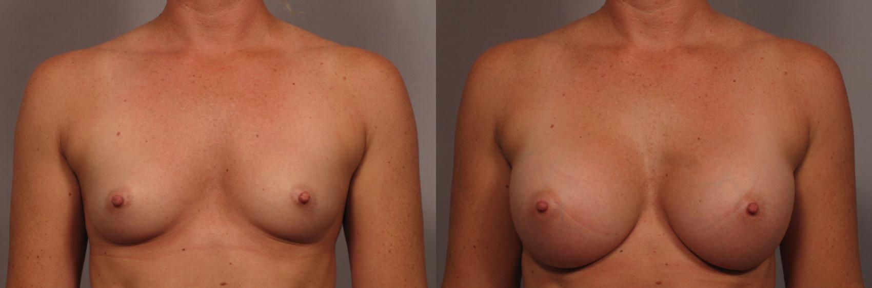 Front view of 31 year old female patient of Dr. Kent Hasen Underwent Breast Augmentation, Before