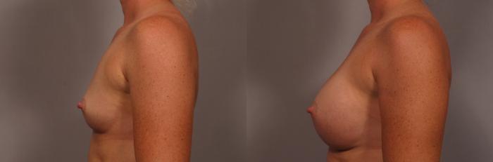 Left Side view of 31 year old female patient of Dr. Kent Hasen Underwent Breast Augmentation, Before