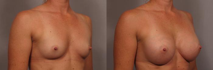 Right Oblique view of 31 year old female patient of Dr. Kent Hasen Underwent Breast Augmentation, Before
