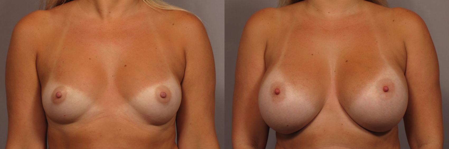 Front view of 30 year old breast augmentation patient of Dr. Kent Hasen, Before