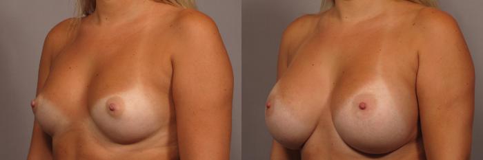 Left Oblique view of 30 year old breast augmentation patient of Dr. Kent Hasen, Before