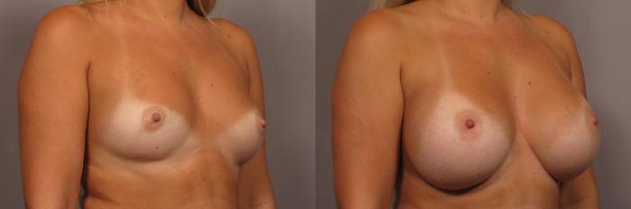 Right Oblique view of 30 year old breast augmentation patient of Dr. Kent Hasen, Before
