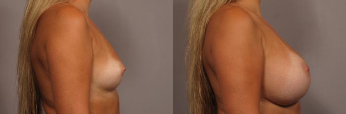 Right Side view of 30 year old breast augmentation patient of Dr. Kent Hasen, Before