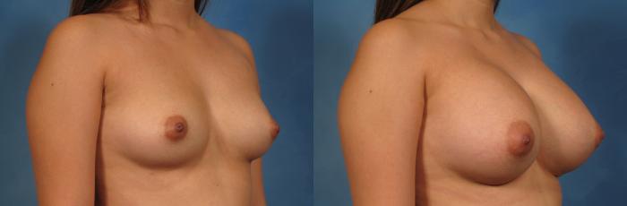Right Oblique view of a 22-year-old woman who had breast augmentation by Dr. Kent Hasen,  Before