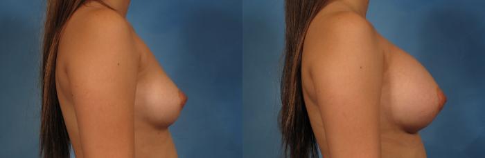 Right Side view of a 22-year-old woman who had breast augmentation by Dr. Kent Hasen, Before