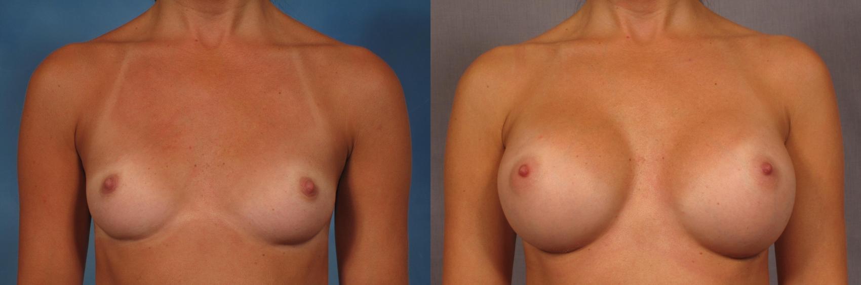 Front view of a 30-year-old breast augmentation patient of Dr. Kent Hasen, Before