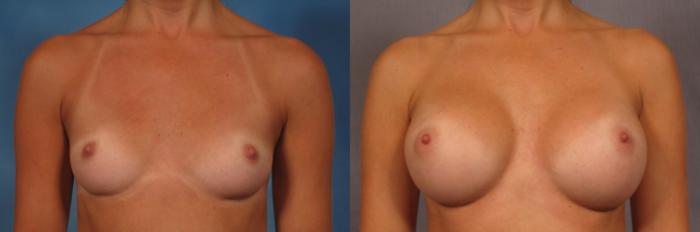 Front view of a 30-year-old breast augmentation patient of Dr. Kent Hasen, Before