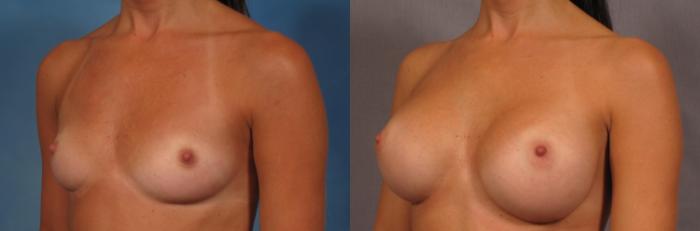 Left Oblique view of a 30-year-old breast augmentation patient of Dr. Kent Hasen, Before
