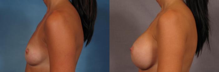 Left Side view of a 30-year-old breast augmentation patient of Dr. Kent Hasen, Before