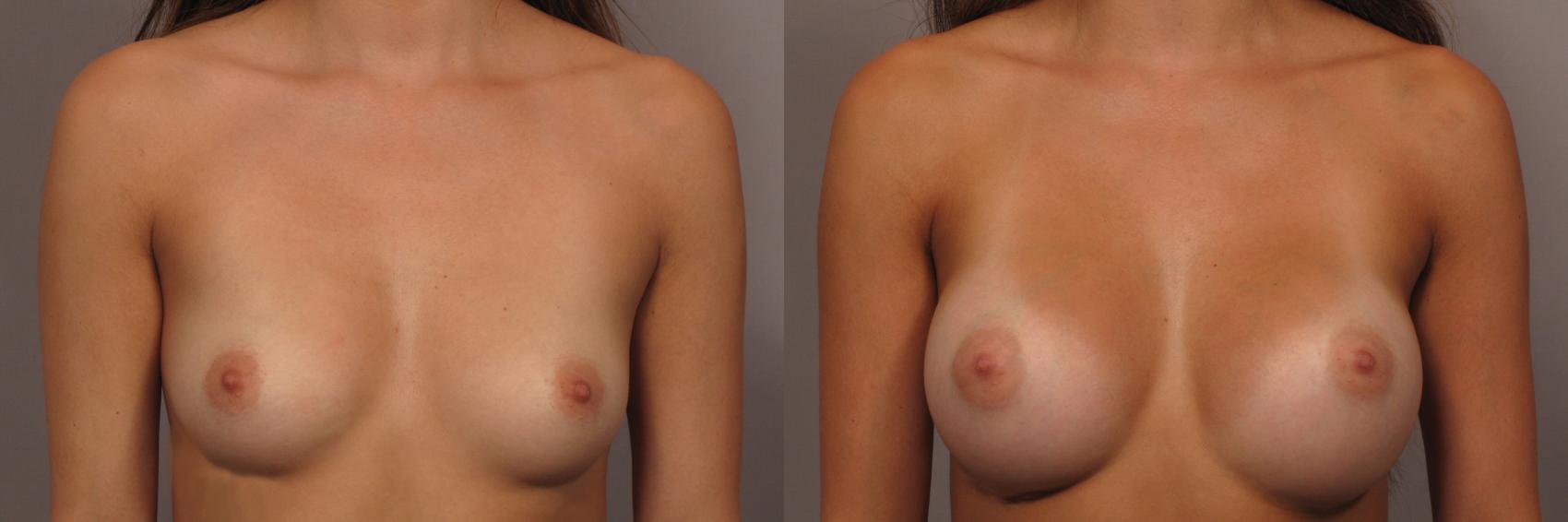 Front view of 23 year old patient of Dr. Kent Hasen who underwent Silicone Breast Augmentation, Before