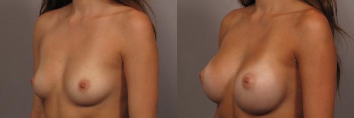 Left Oblique view of a 23-year-old patient of Dr. Kent Hasen who underwent Silicone Breast Augmentation, Before