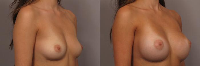 Right Oblique view of a 23-year-old patient of Dr. Kent Hasen who underwent Silicone Breast Augmentation, Before