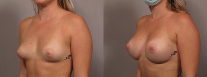 Breast Augmentation Left Oblique View Before