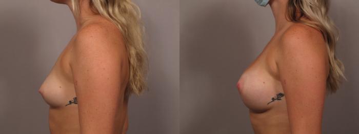 Breast Augmentation Left Side View Before