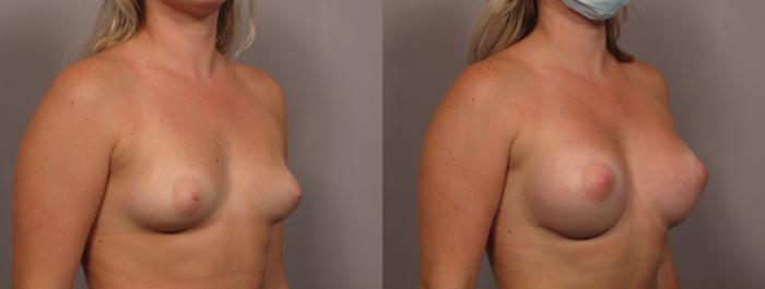 Breast Augmentation Right Oblique View Before