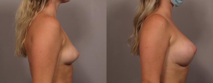 Breast Augmentation Right Side View Before