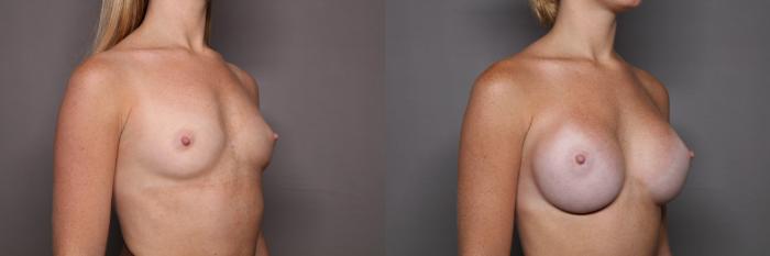 Breast Augmentation Right Oblique View Before