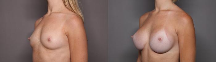 Breast Augmentation Left Oblique View Before