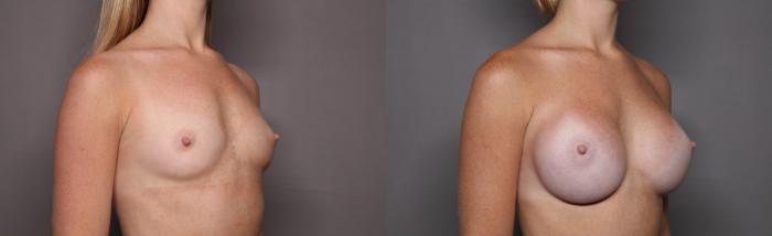 Breast Augmentation Right Oblique View Before
