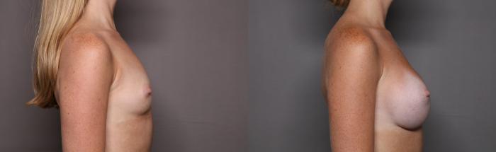 Breast Augmentation Right Side View Before