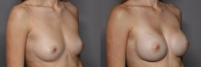 Right Oblique, Pre-op