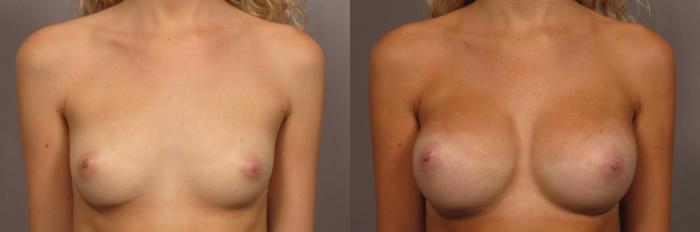 Front view, pre-op