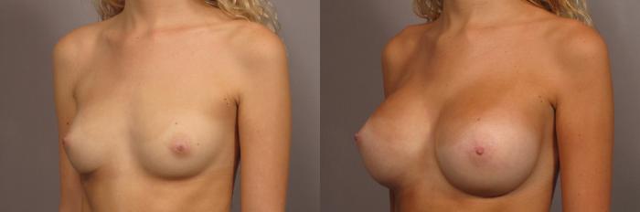 Left Oblique, pre-op