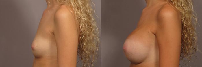 Left Side, pre-op