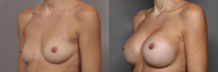 Left Oblique View, Pre-op Breast Augmentation with Silicone Implants