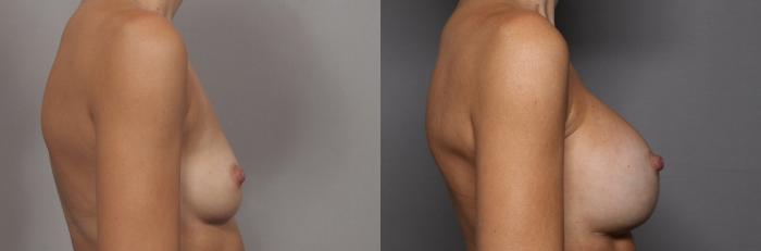 Right Side View, Pre-op Breast Augmentation with Silicone Implants