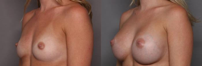 Left Oblique View, Pre-op Breast Augmentation with Mentor Boost Silicone Implants
