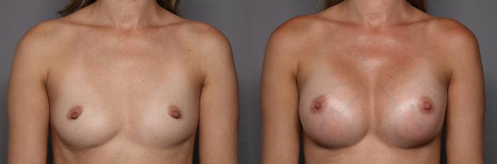 Front, preop before after Motiva Breast Augmentation