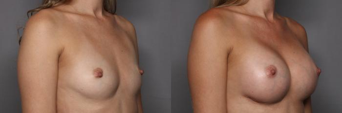 Right Oblique, preop before Motiva Breast Augmentation