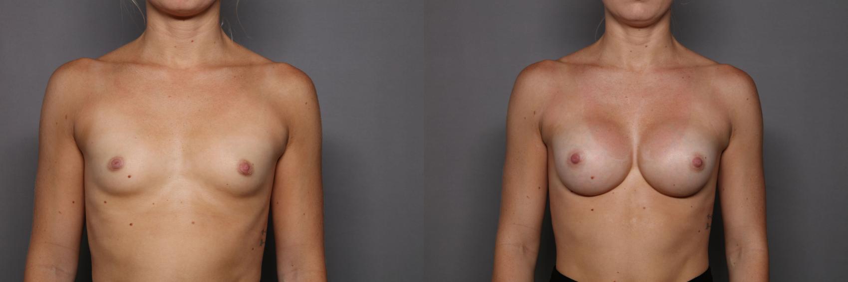 Before & After Breast Augmentation Case 463 Front View in Naples and Ft. Myers, FL