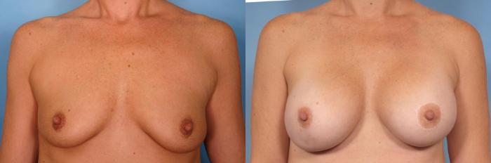 Before & After Breast Augmentation Case 47 View #4 View in Naples and Ft. Myers, FL