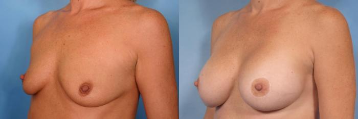 Before & After Breast Augmentation Case 47 View #5 View in Naples and Ft. Myers, FL