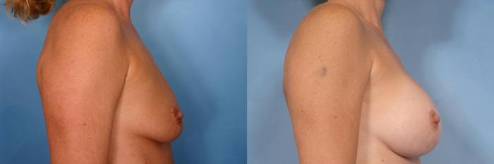 Before & After Breast Augmentation Case 47 View #6 View in Naples and Ft. Myers, FL