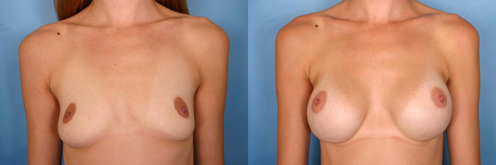 Before & After Breast Augmentation Case 60 View #1 View in Naples and Ft. Myers, FL
