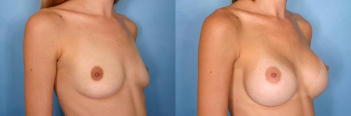 Before & After Breast Augmentation Case 60 View #2 View in Naples and Ft. Myers, FL