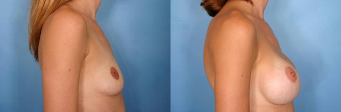 Before & After Breast Augmentation Case 60 View #3 View in Naples and Ft. Myers, FL