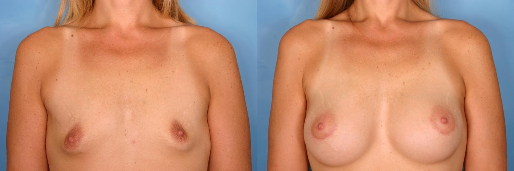 Before & After Breast Augmentation Case 67 View #1 View in Naples and Ft. Myers, FL