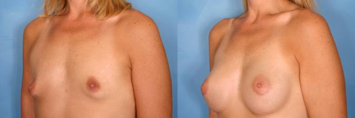 Before & After Breast Augmentation Case 67 View #2 View in Naples and Ft. Myers, FL